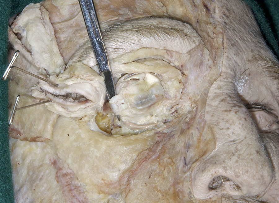 Cutting the Extraocular Muscles