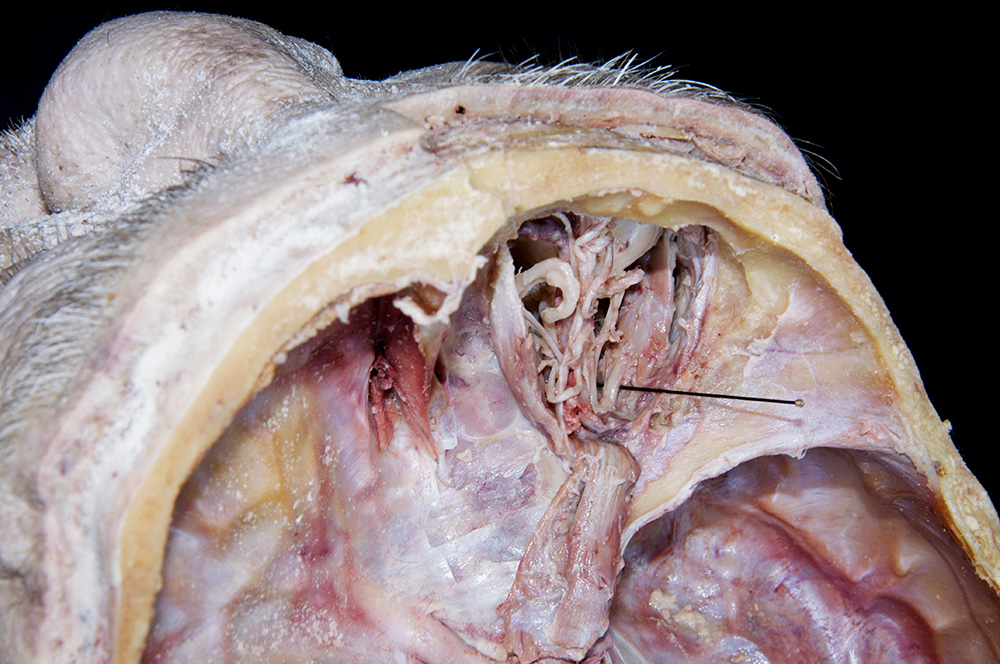 Lateral Rectus Muscle