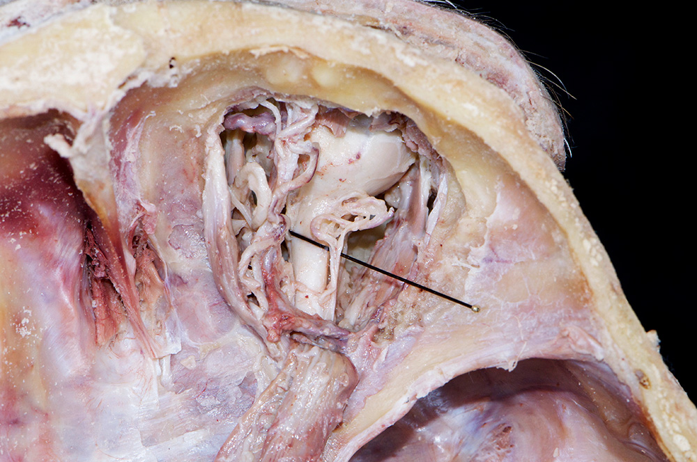Optic Nerve