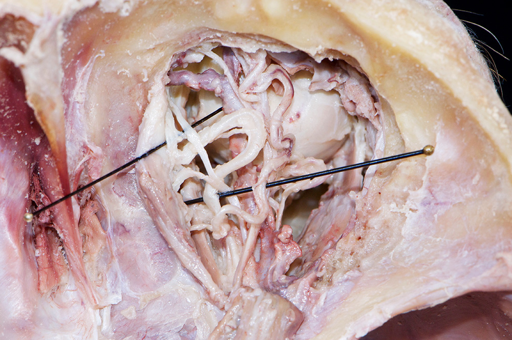 Ophthalmic Artery