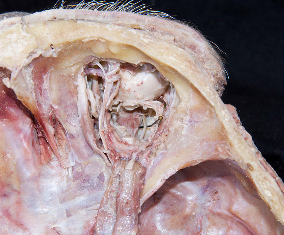 Inferior Rectus Muscle