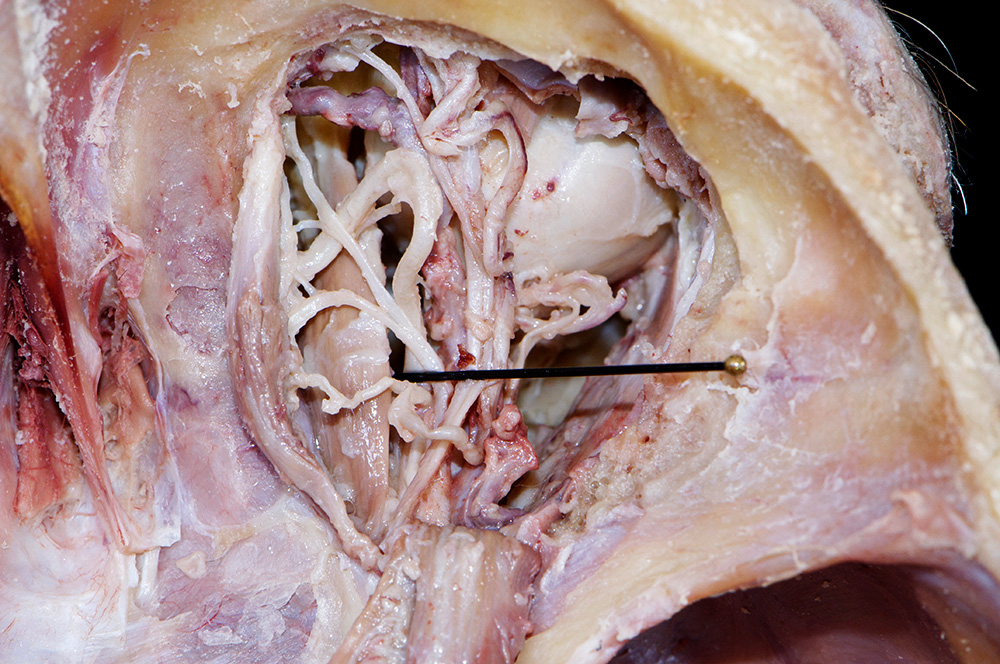 Medial Rectus Muscle
