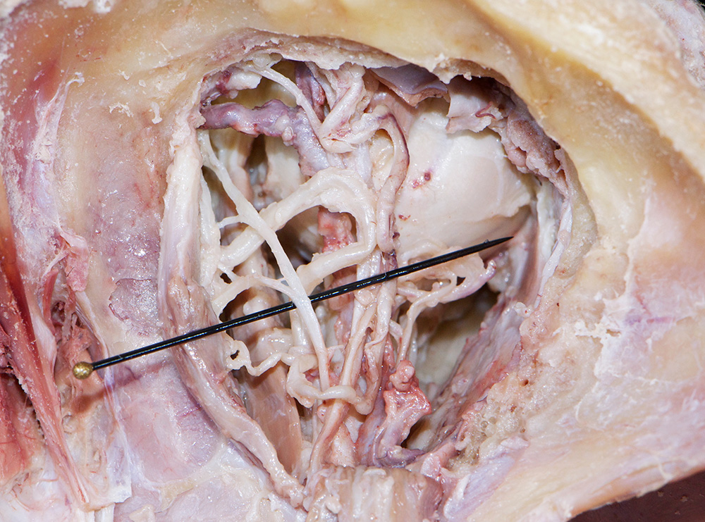 Nasociliary Nerve