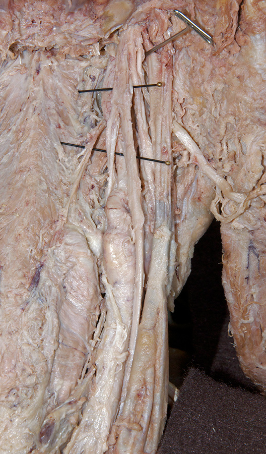 Superior Laryngeal Branching from Vagus Nerve