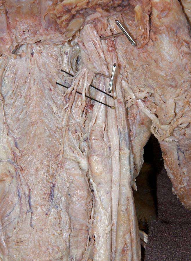 Glossopharyngeal Nerve