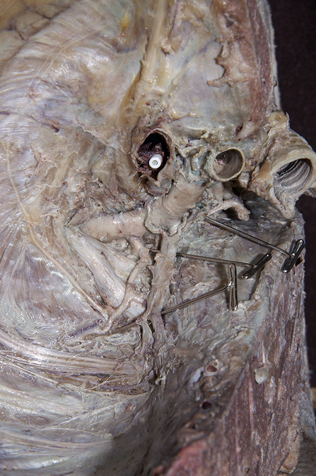 Inferior Cervical Ganglion (inferior/thoracic view)
