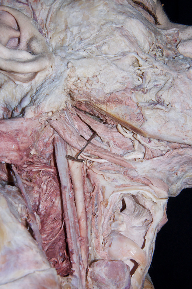 Styloglossus Muscle