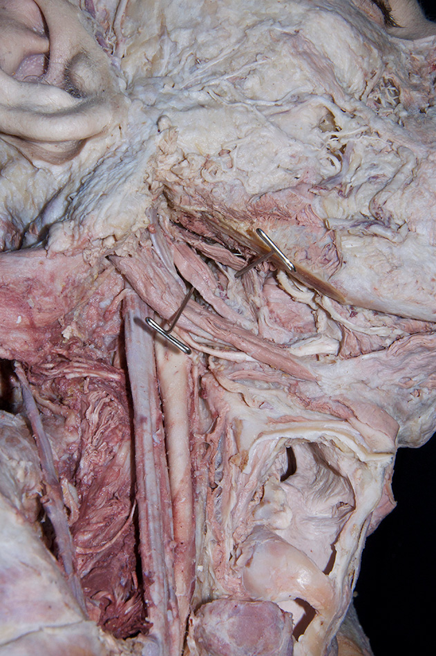 Stylopharyngeus Muscle