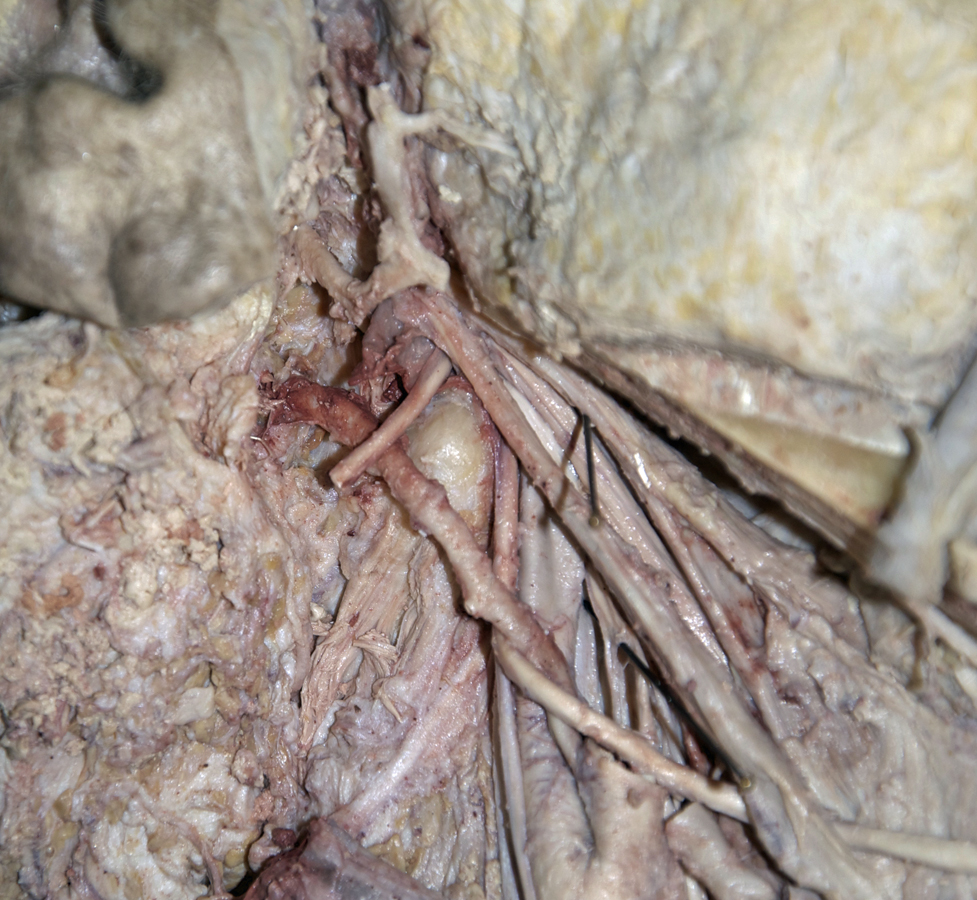 Right Facial Nerve (at stylomastoid foramen; inferior-lateral view)