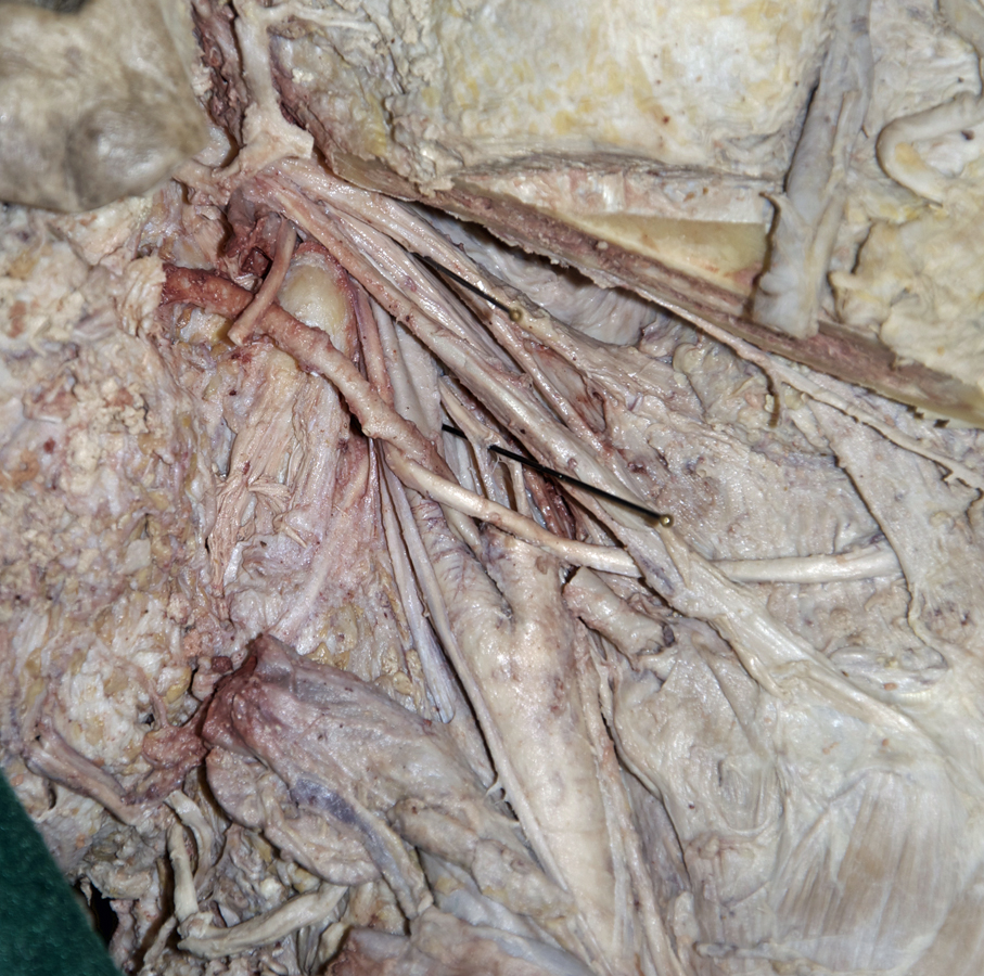 Right Superior Laryngeal Nerve (inferior-lateral view)
