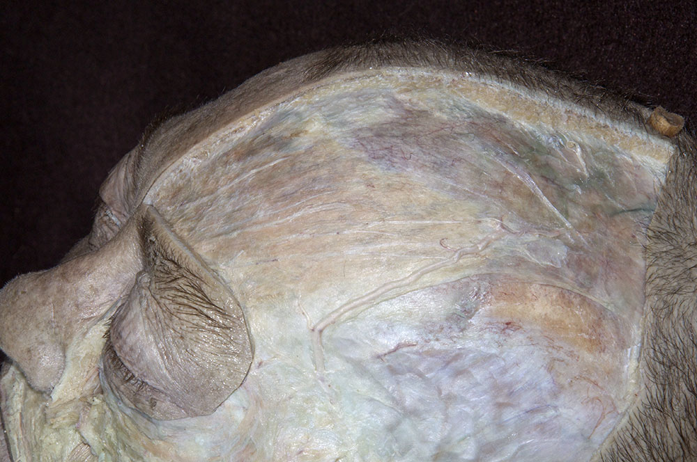 Frontalis Muscle