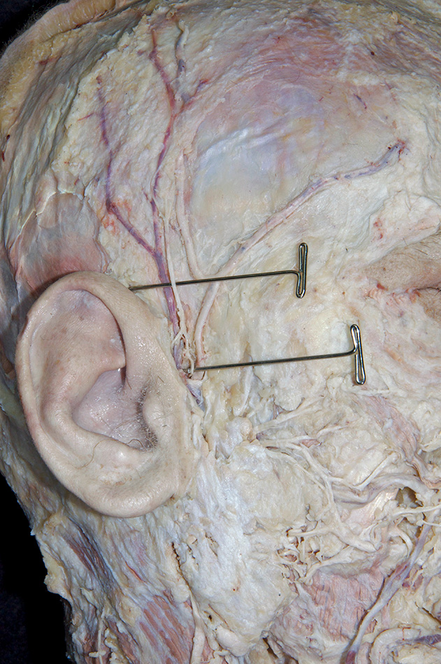 Auriculotemporal Nerve