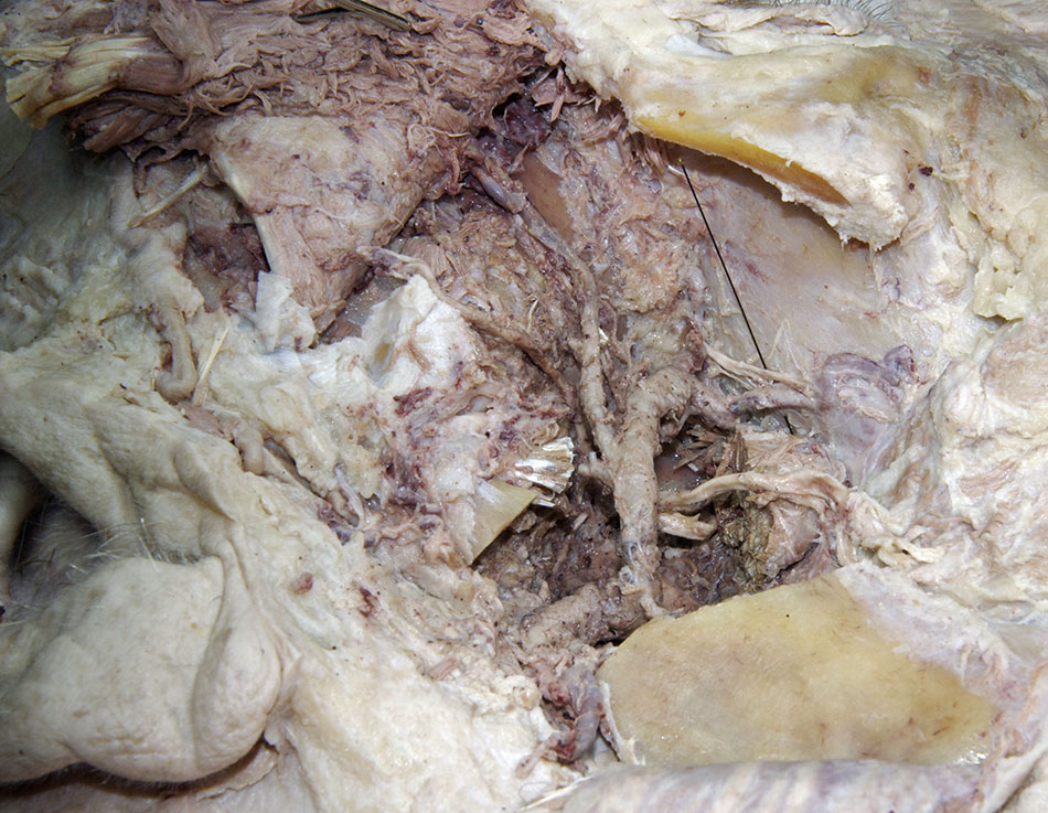 Posterior Superior Alveolar Nerve and Artery
