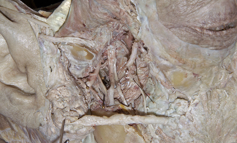 Sphenomandibular Ligament