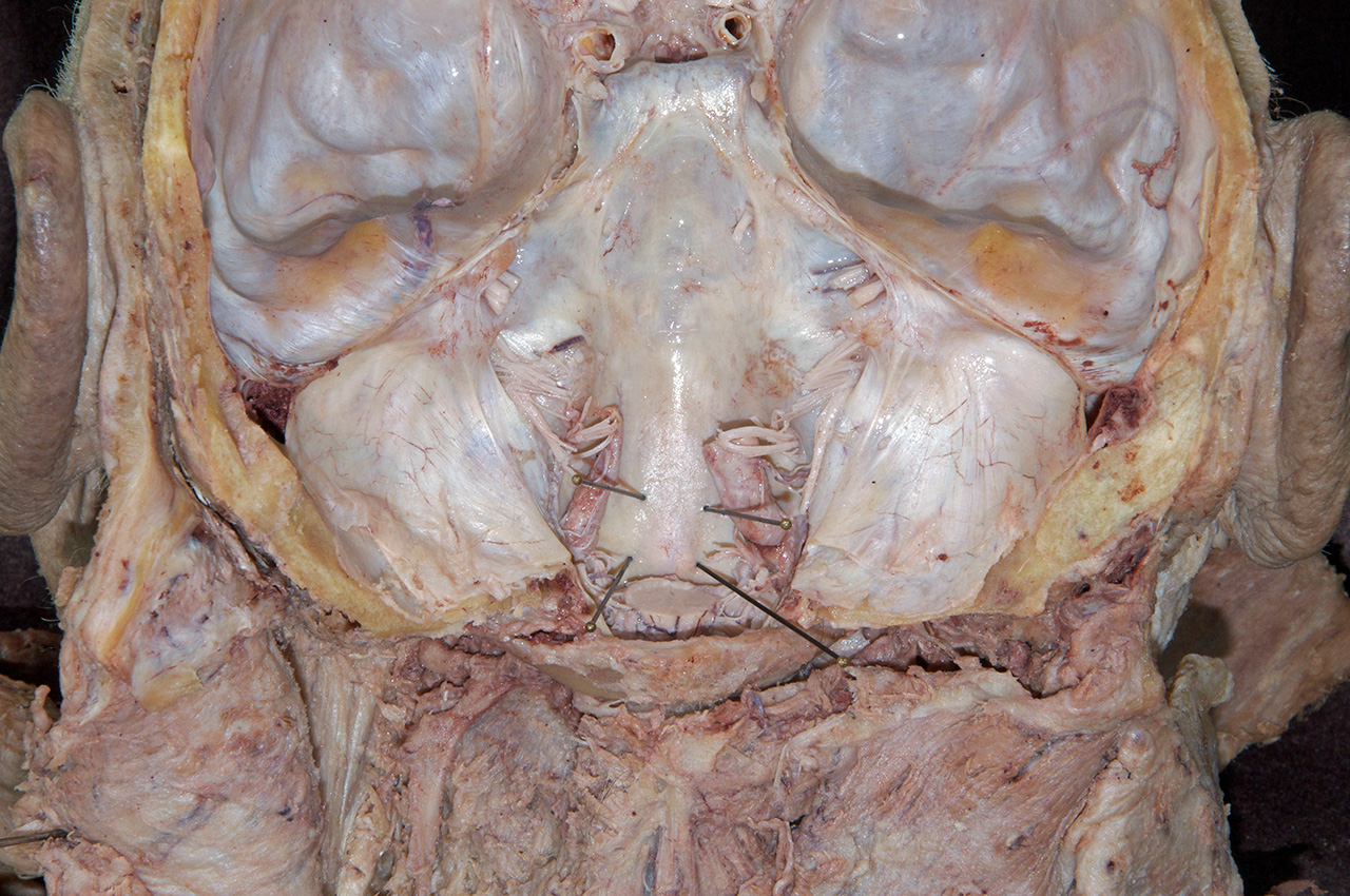 Dens Covered by Dura and Tectorial Membrane