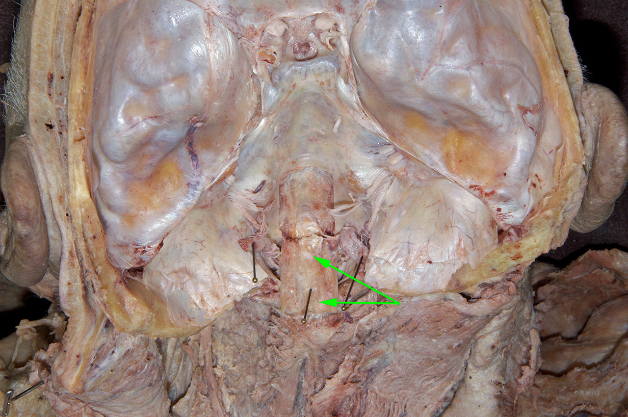 Reflected Dura and Tectorial Membrane
