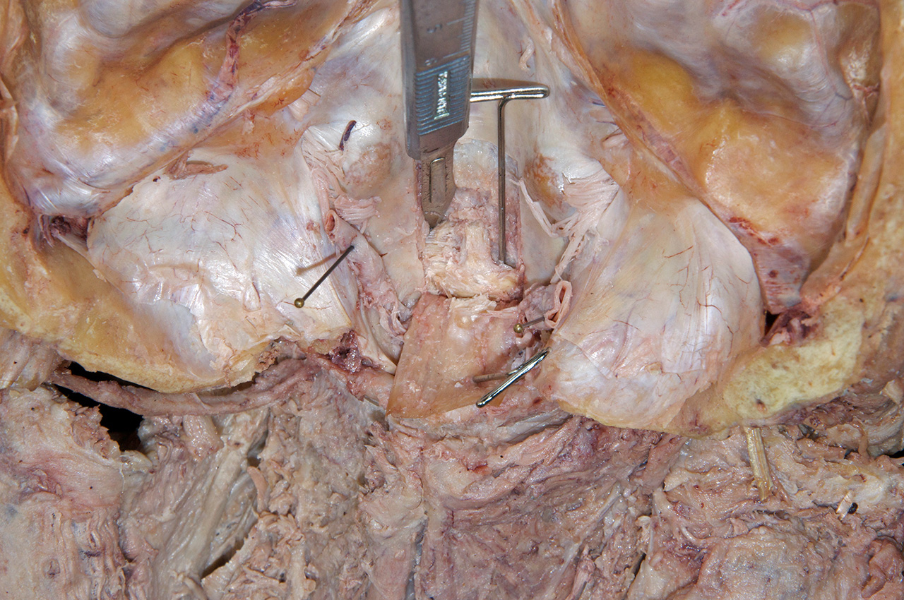 Cutting the Alar Ligaments