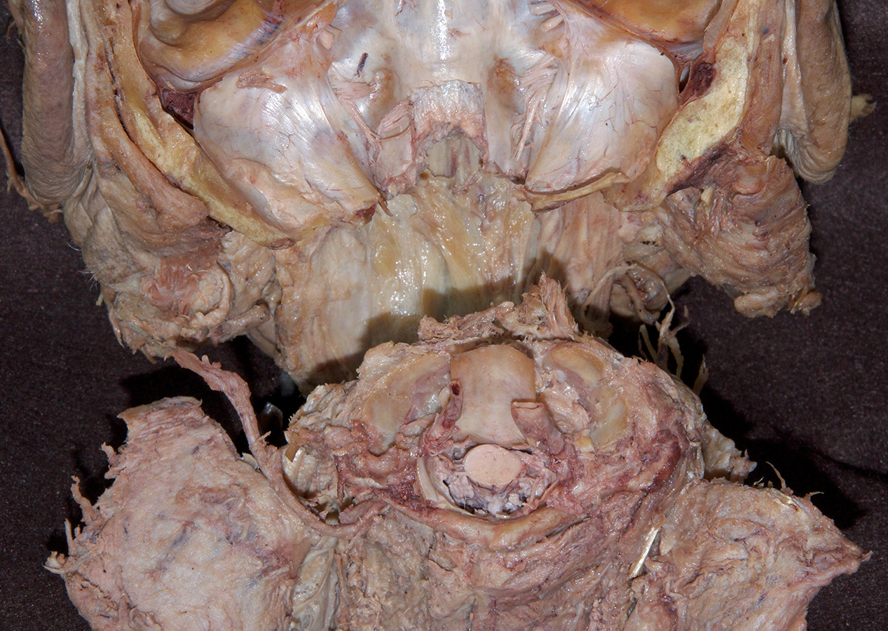 Disarticulated Atlanto-occipital Joint