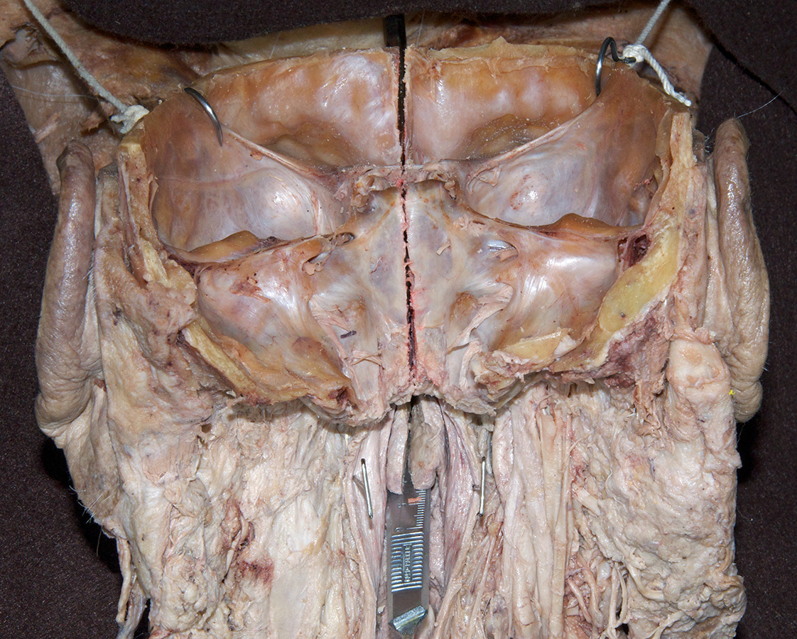 Bisected Cranial Base