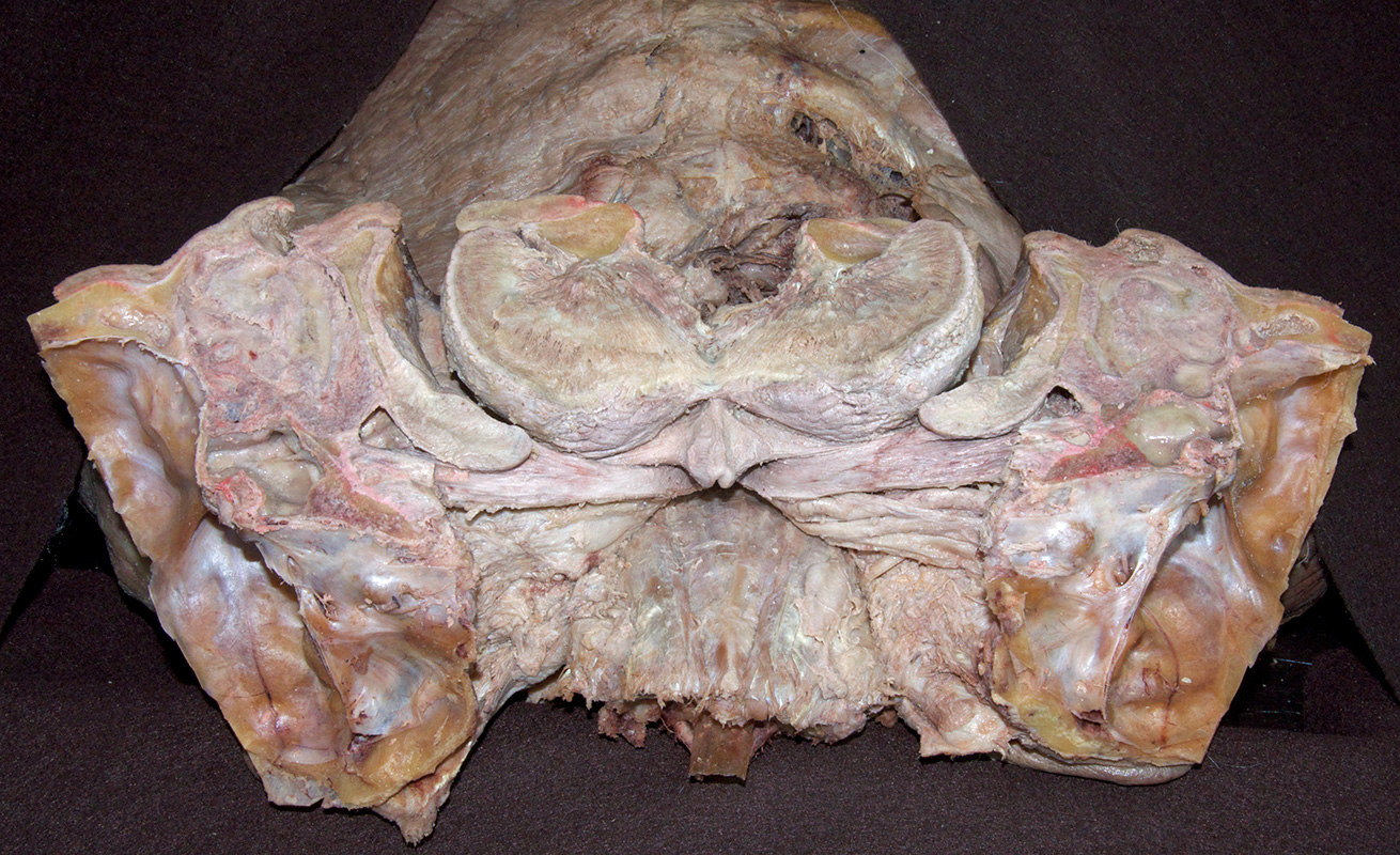 Bisected Mandible and Tongue
