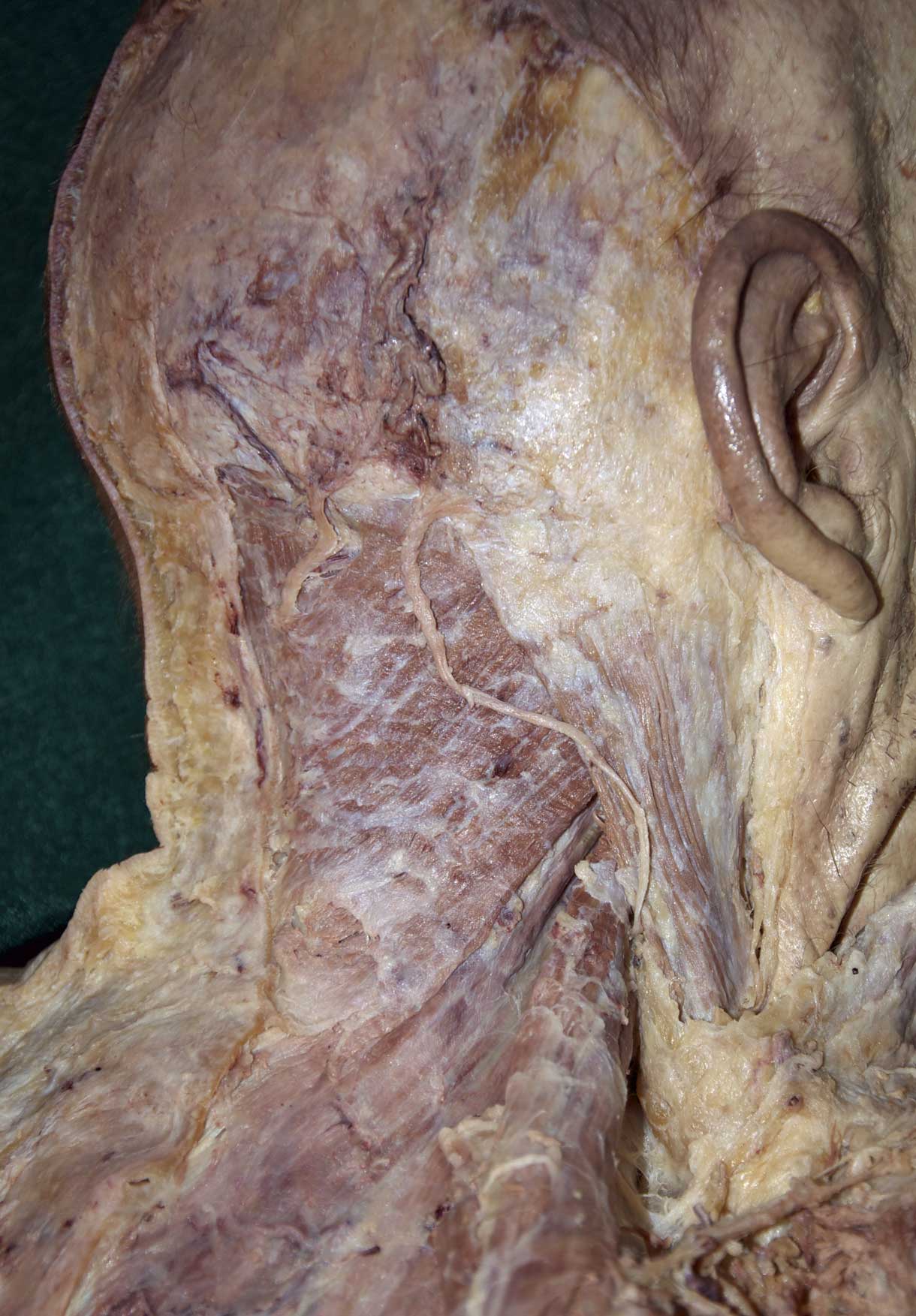 Posterior Neck - 1