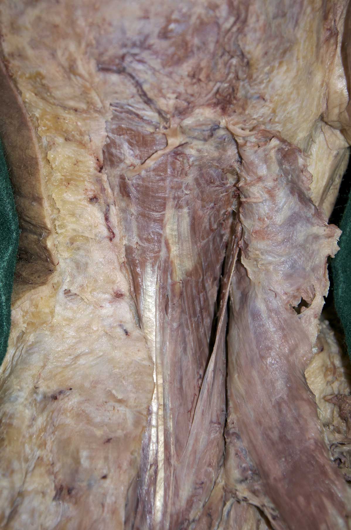 Posterior Neck - 2