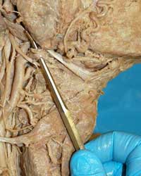 Deep Carotid Triangle-I