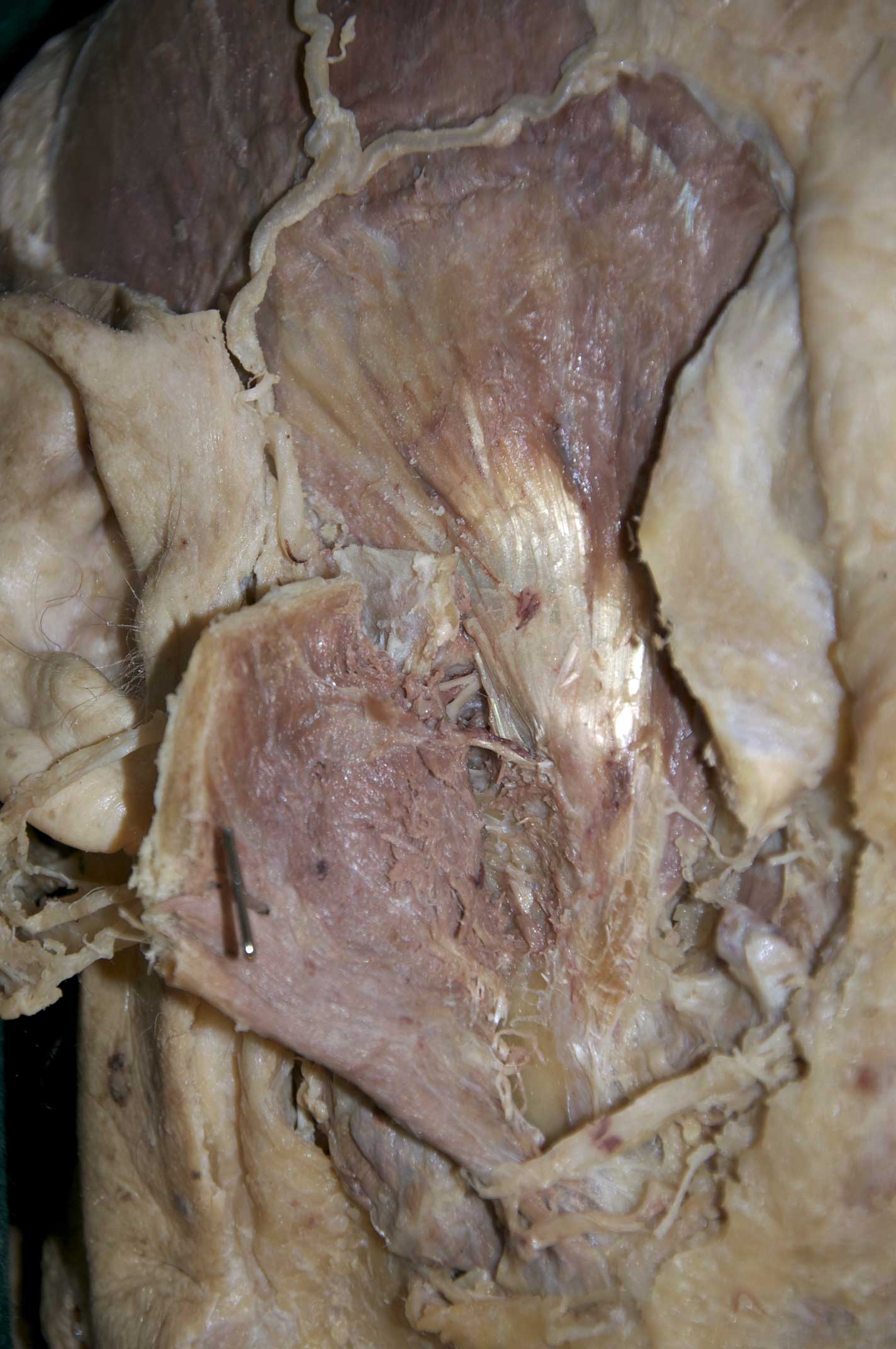 Infratemporal Fossa - 1