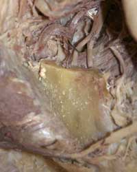 Infratemporal Fossa - Level of the Mandibular Foramen