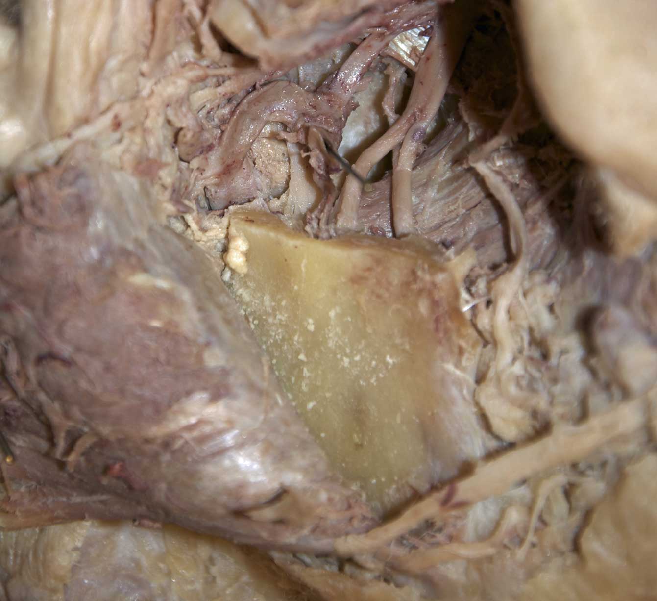 Infratemporal Fossa - 4