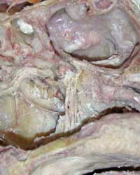 Pterygopalatine Fossa