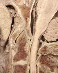 Median Atlantoaxial Joint