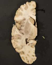 Brain - Horizontal Section