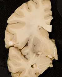 Brain - Frontal Section