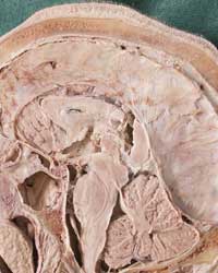 Cranial Cavity - Median Section
