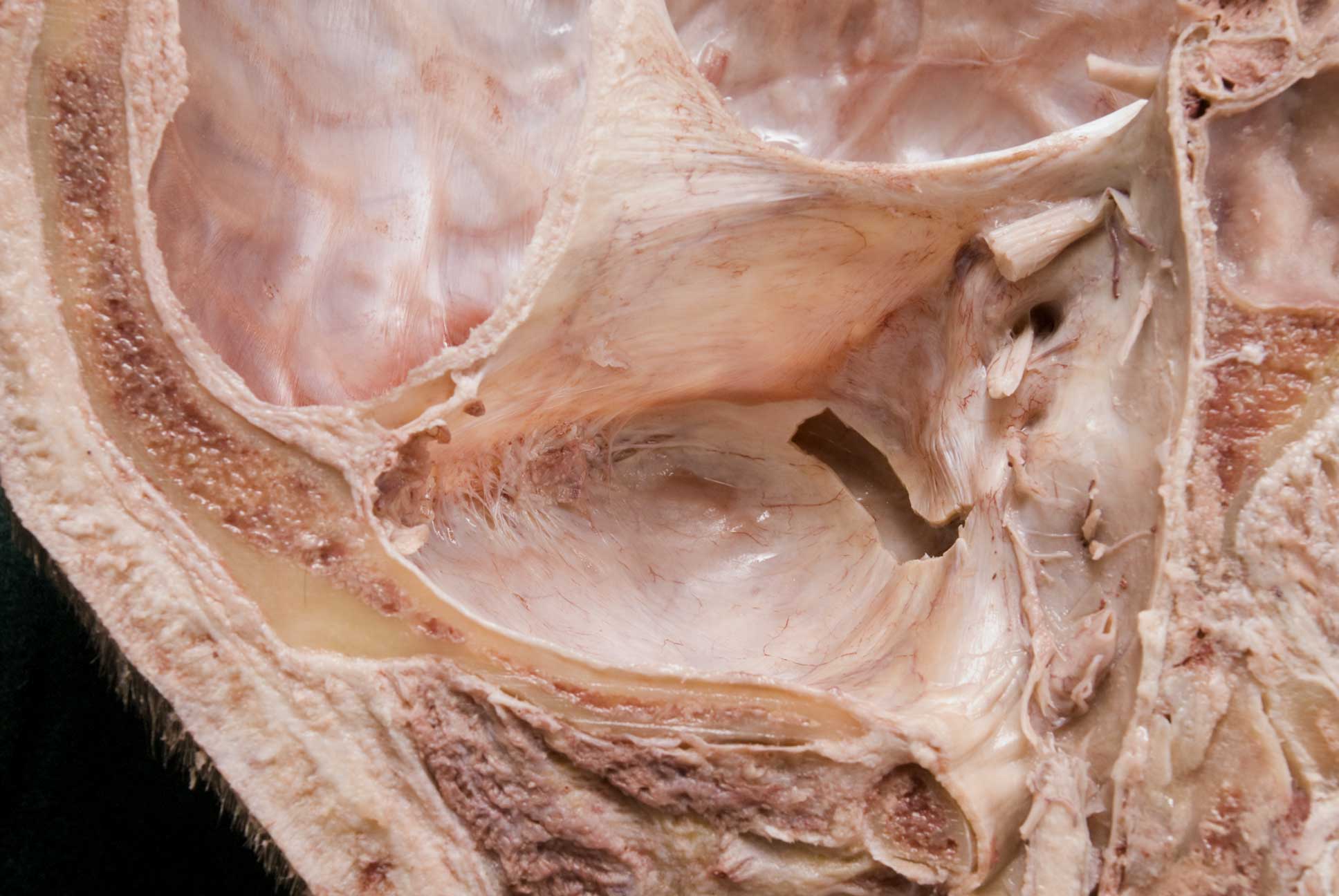 Cranial Cavity - 3