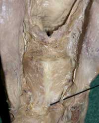 Posterior Larynx