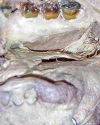 Floor of Oral Cavity