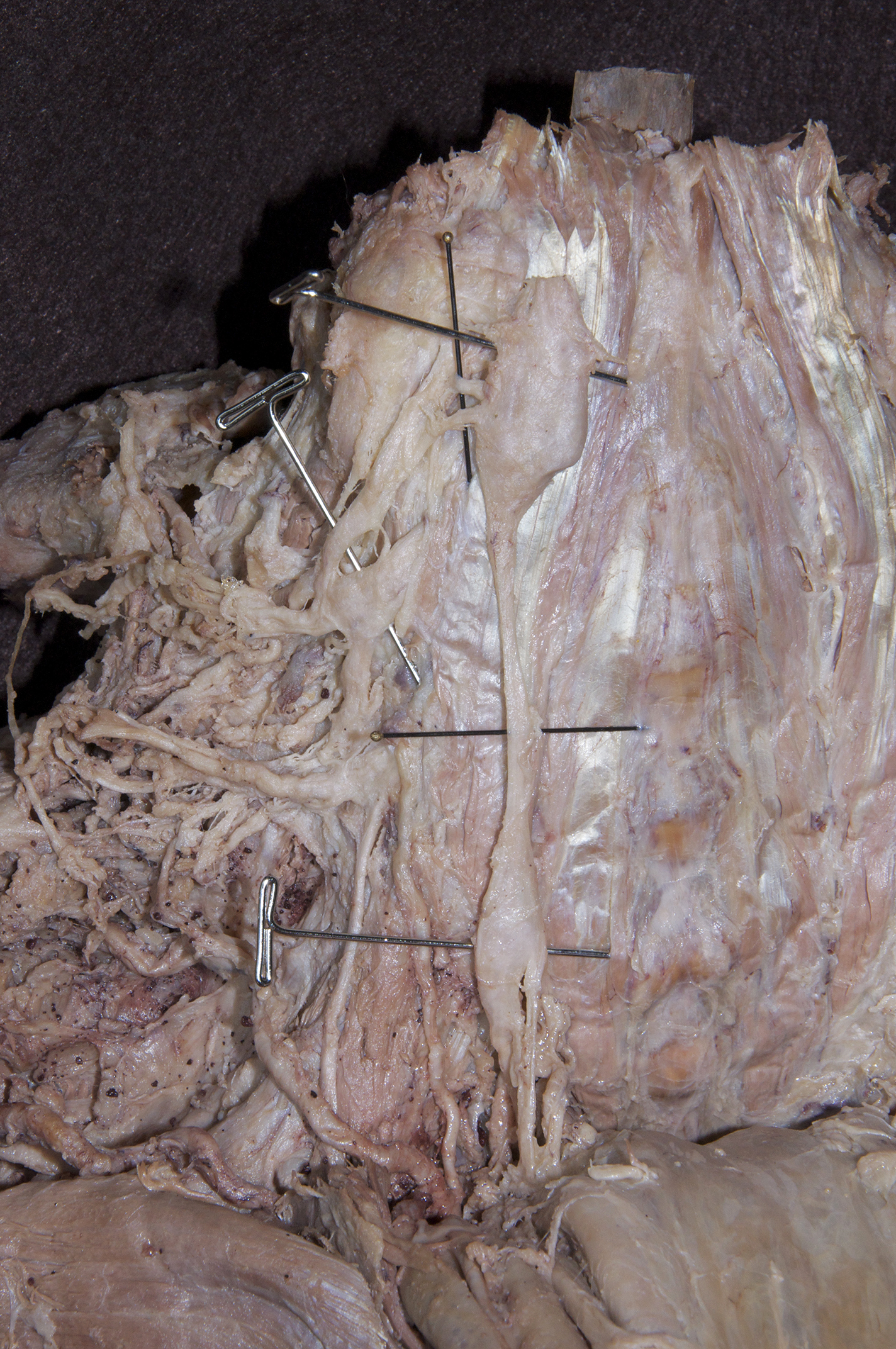 Prevertebral Region - 5