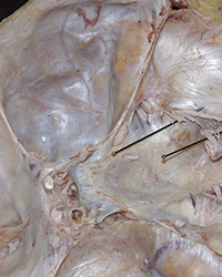 Middle Cranial Fossa