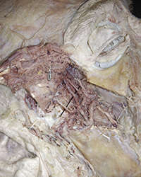 Infratemporal Fossa - Level of the Mandibular Foramen