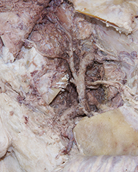 Infratemporal Fossa - Level of the Mandibular Foramen