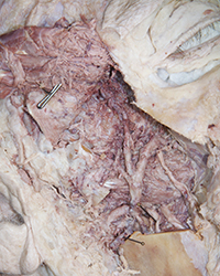 Infratemporal Fossa - Level of the Mandibular Foramen
