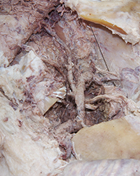 Infratemporal Fossa - Level of the Mandibular Foramen