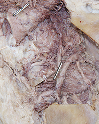 Infratemporal Fossa - Level of the Mandibular Foramen