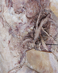 Infratemporal Fossa - Level of the Mandibular Foramen