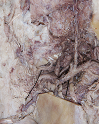 Infratemporal Fossa - Level of the Mandibular Foramen