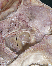 Pterygopalatine Fossa