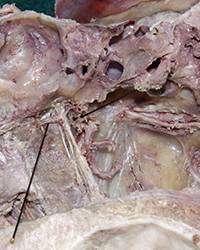 Pterygopalatine Fossa