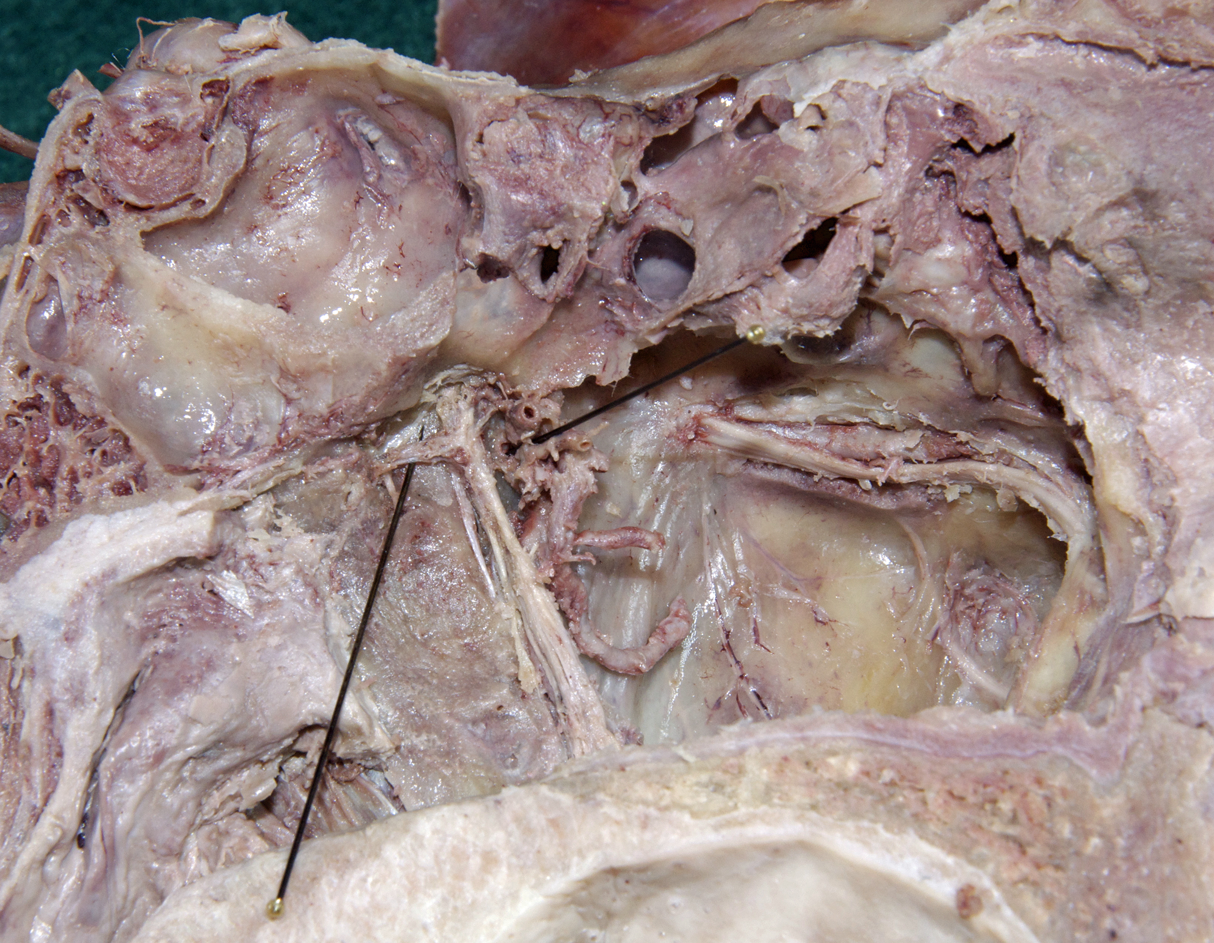 Nasal Cavity - 5